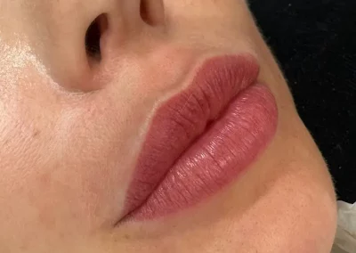 Lippenkonturierung