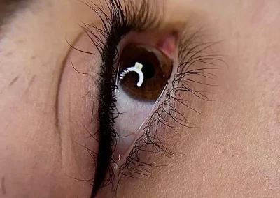 Wimpernkranzverdichtung